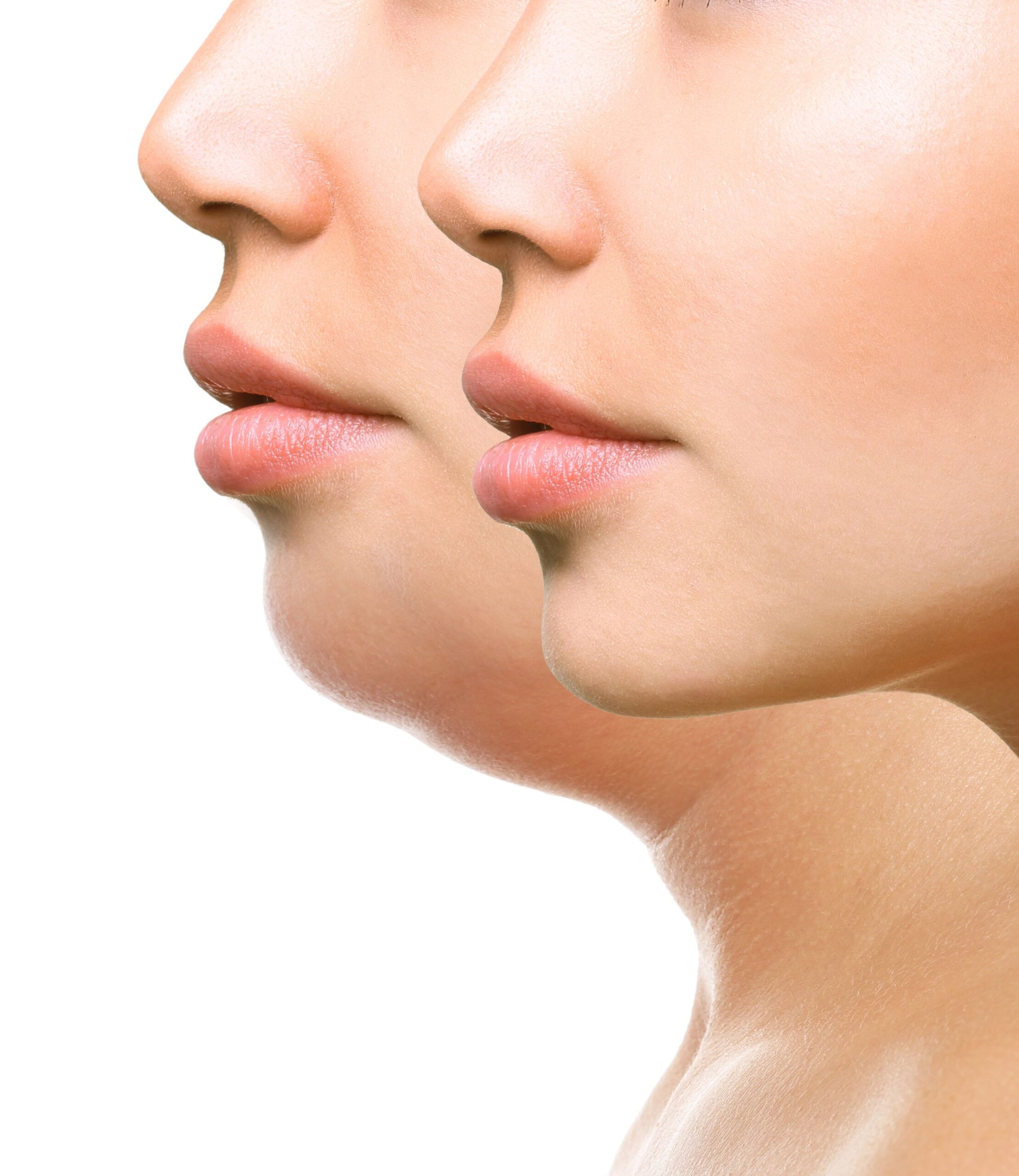 Kybella Treatment in Fort Lauderdale, FL by BodyhackRX